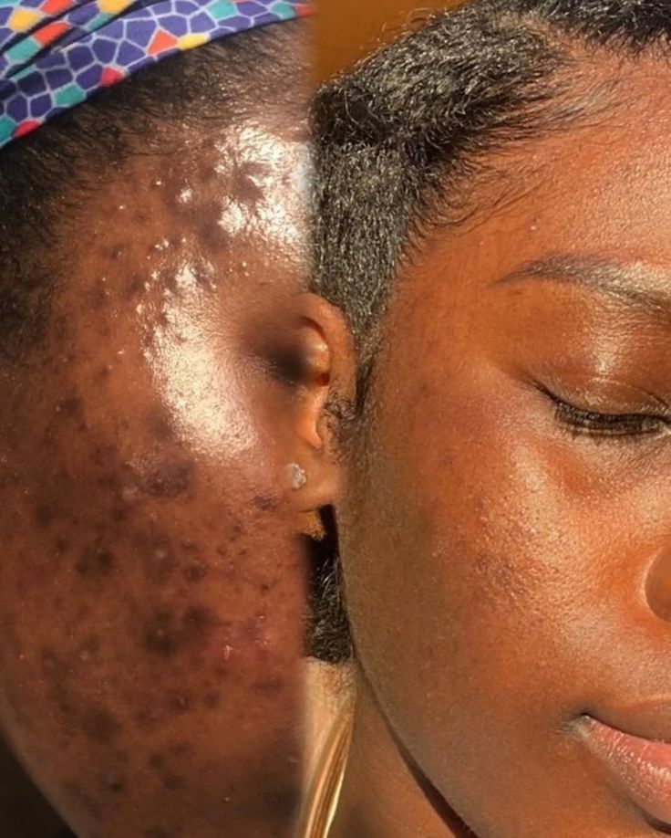 Darkspot sérum for normal skin - Image 2